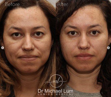 Cheek filler was used to rebalance the face and restore a natural, more youthful look