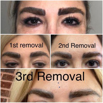 Removal of badly tattooed eyebrows