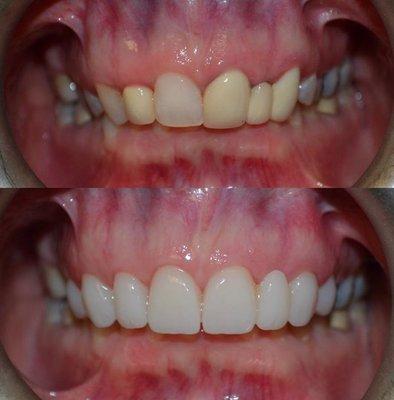 Before and after cosmetic crowns, bridge and veneers #cosmeticdentistphiladelphia