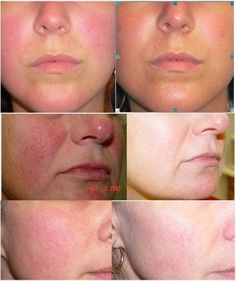 Genesis Treatment for Rosacea