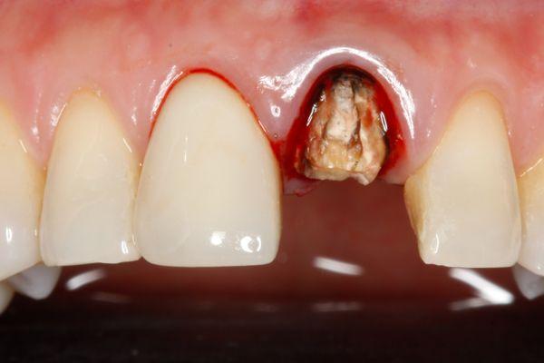 Broken tooth as a result of cavity