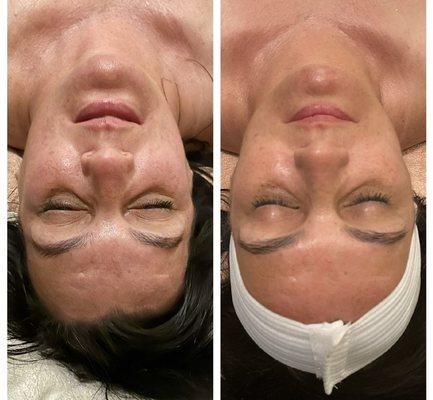 Amazing results from an aging targeted facial from this beauty