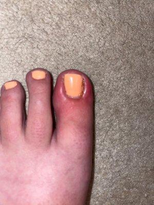 Infected toe