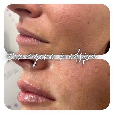 Lip fillers address:

 Uneven lip shape

 Wrinkles around the mouth

 Smoker's lines

 An undefined vermilion border