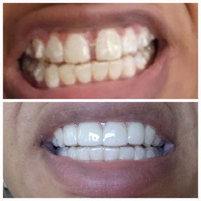 Before and After Invisalign Treatment at SmileHQ