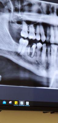 Broken tooth due to bad root canal