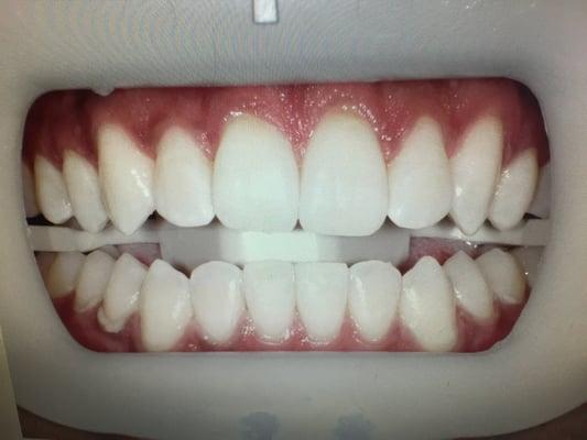 Whitening case: after treatment.