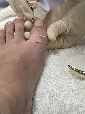 Ingrown toe nail.