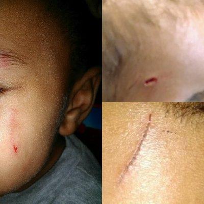 BEWARE! According to a teacher there these injuries are normal for kids attending there preschool