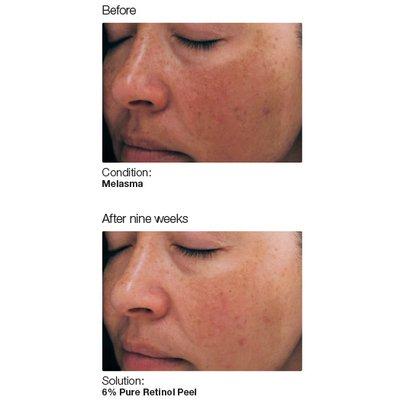 PCA Peels for Visible Aging and Hyperpigmentation