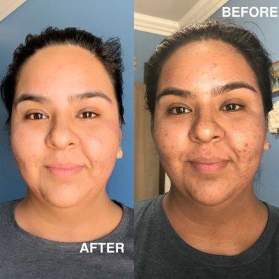 Post Acne Scar Treatment