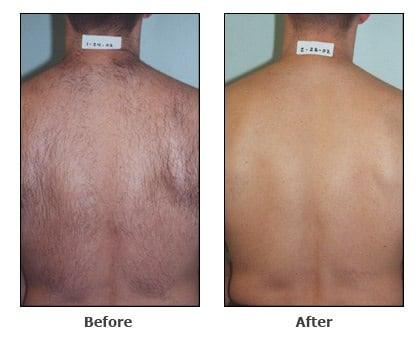 Before and after laser hair removal