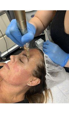 Microneedling! Our favorite anti aging treatment!