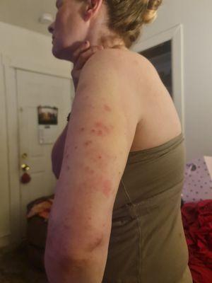 Bed bug bites on a friend she stayed with me for a week lost her job because they thought she was a heroin addict