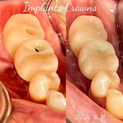 Implants the best choice to replace missing teeth!