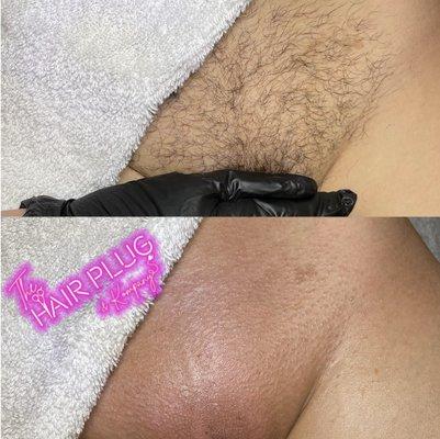 Laser hair removal in Union City, NJ