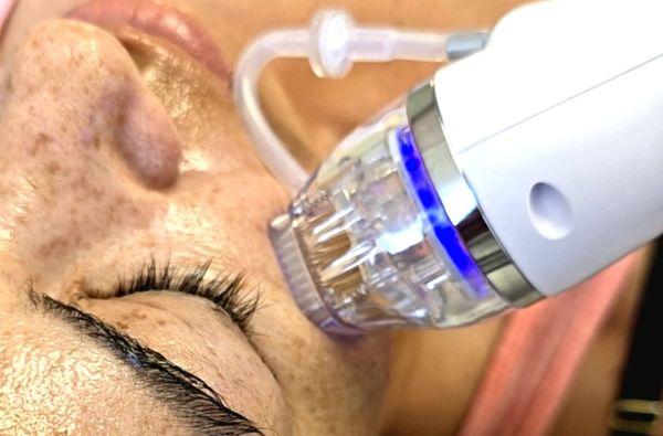 RF Microneedling for Tightening Skin and remove wrinkles