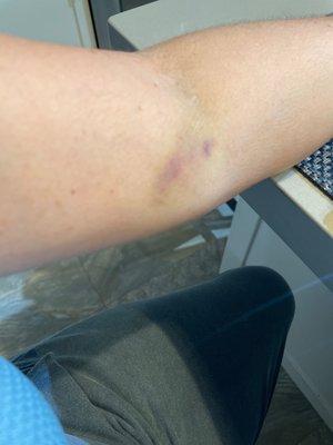 Bruise from the needle when they took out blow d in quest