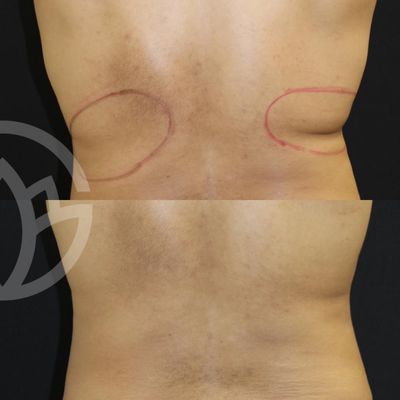 CoolSculpting results