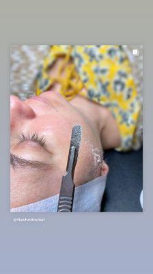 Dermaplaning Facial - Dead skin cells & vellus hair collected on our professional surgical grade blade