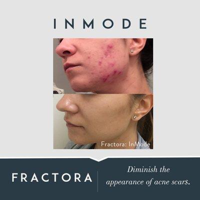 FRACTORA is available at Feeling Beautiful! The BEST treatment to DIMINISH acne scars.