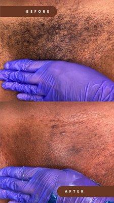 Before and After of a Brazilian Wax.