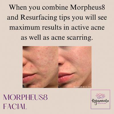 Before and After morpheus8 on acne and acne scarring