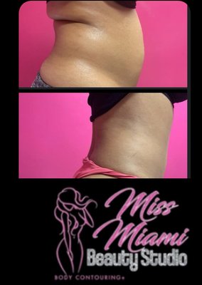 Results in one session of Lymphatic Massage with Wood Work, Lipo Cavitation, and RF Skin Tightening