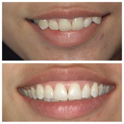 Orthodontics without removing teeth.