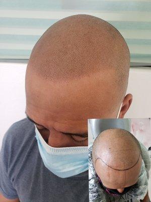 Doing what we love Scalp Micropigmentation!