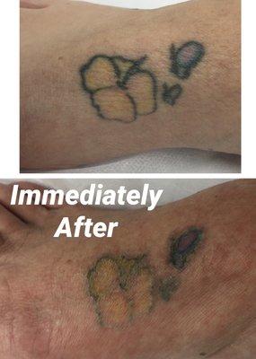 Tattoo Removal