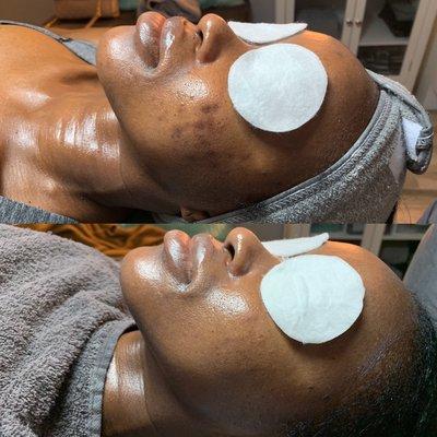 Acne and hyperpigmentation treatment results