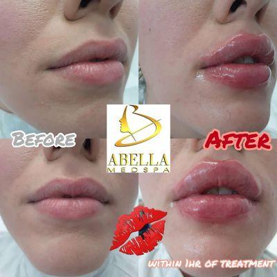 Lips augmentation