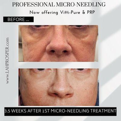 Before and after medical aesthetic micro-needling addressing fine lines, hyperpigmentation, & rosacea