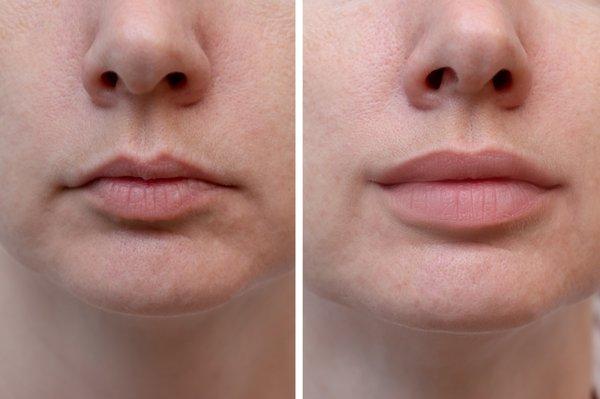 Dr. G specializes in lip filler as a natural enhancement.