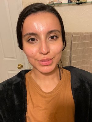 My skin after microneedling. Have some redness and flaking which is normal. Just look at my glow though!