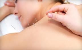 gentle acupuncture tx