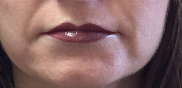 Immediately after full lip. Again little blue dots define the edge of the lip and will disappear usually by the next day.