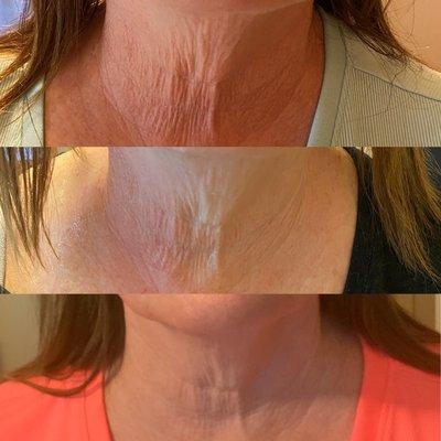 Skin Tightening with Radiofrequency 
4 treatments