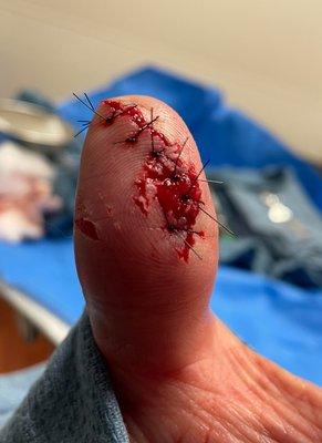 8 stitches, $1100!