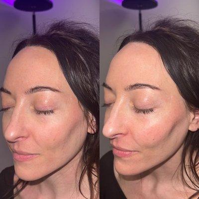 Cheek Augmentation by David the NP