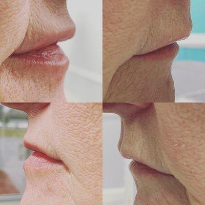 Lip rejuvenation and volume