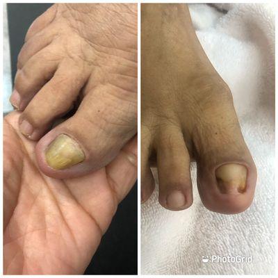 Toenail reduction