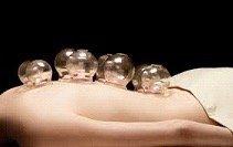 Cupping  is used for pain, blood flow, inflammation, relaxation and well being.  A type of deep tissue massage.