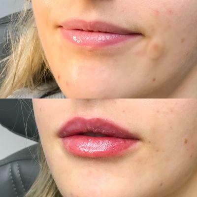 Restylane Kysse Lip Filler