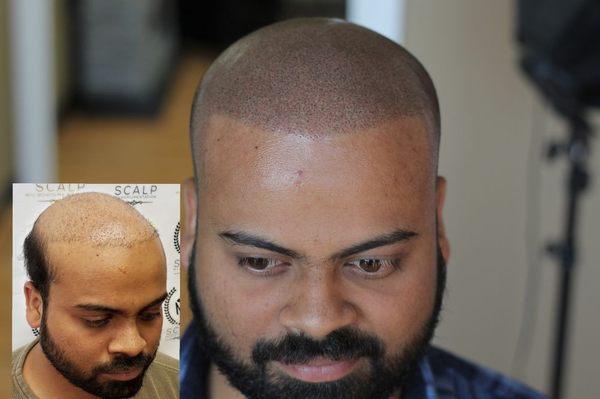 Hair transplant might of failed you. But we wont!!! SCALP MICROPIGMENTATION call today 301-503-0762