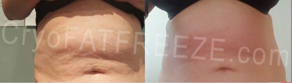 Cryo Fat Freeze for tummy. Shown after 3 treatments. 409-454-9502