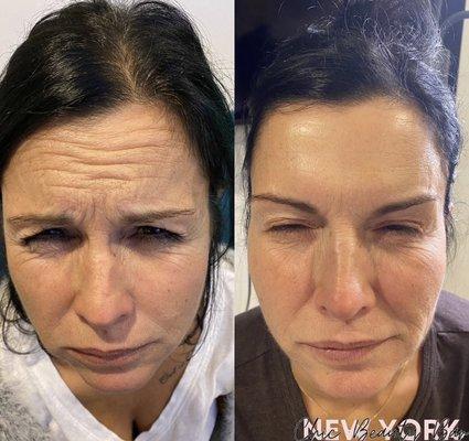 Full Botox treatment (Forehead, Glabella & Crows feet)