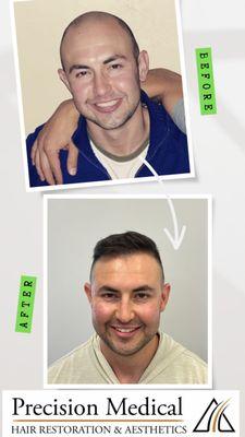 Amazing results for this patient after FUE hair transplant performed by Dr. Plaman at Precision Medical Hair Restoration & Aesthetics!