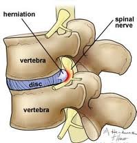 Disc Herniation causing spinal nerve irritation.